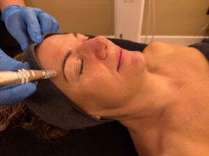 mesoterapia y peeling químico